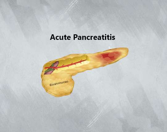 Acute pancreatitis treatment