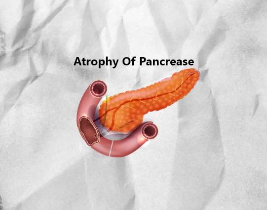 Atrophy Of Pancrease