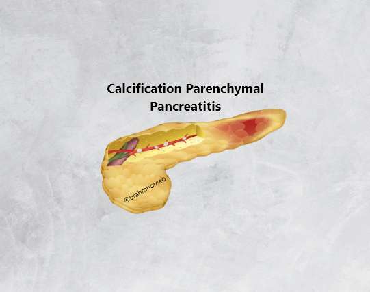 Calcification Of Pancrease