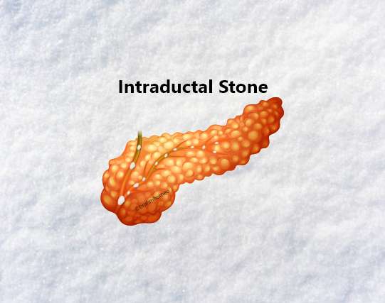 Intraductal Calcification Stone
