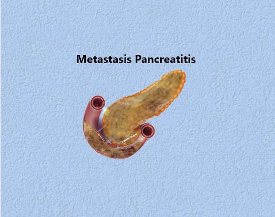 Metastasis Pancreatic Cancer